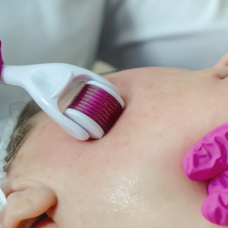 Microneedling