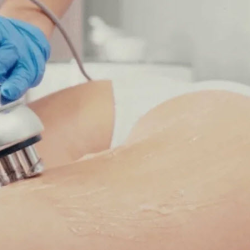 Radio Frequency Skin Tightening