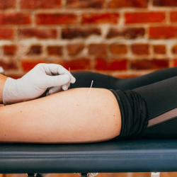 Dry Needling