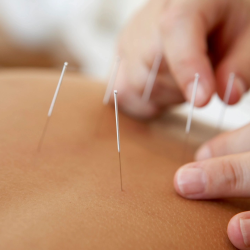 Acupuncture