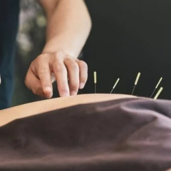 Acupuncture
