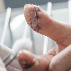 Occupational Cut Treatment
