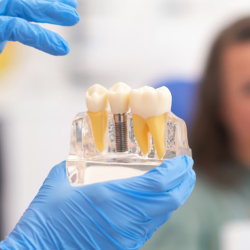 Dental Implants
