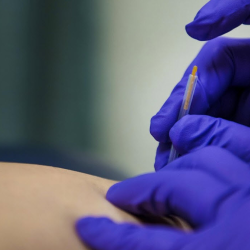 Dry Needling