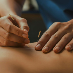 Acupuncture