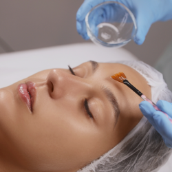 Chemical Peels