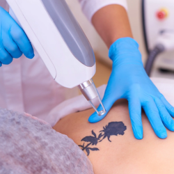 Tattoo Removal