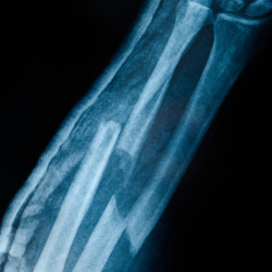 X-rays