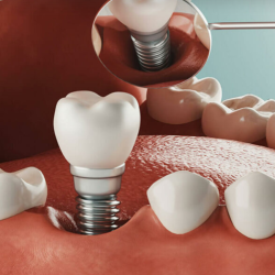 Dental Implants