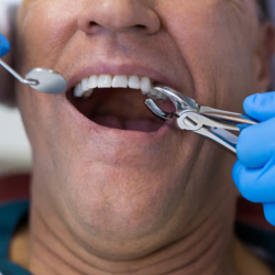 Tooth Extractions