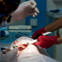Wisdom Teeth Removal