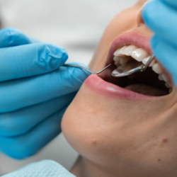 Dental Fillings