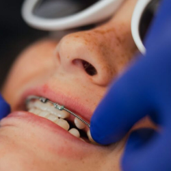 Orthodontic Braces (Metal and Ceramic)