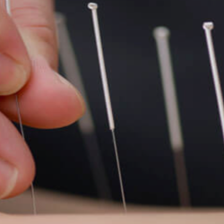 Acupuncture