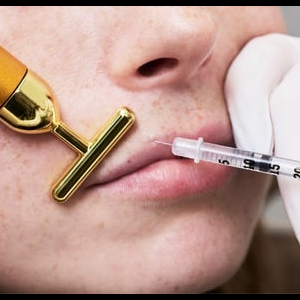Dermal Filler (Hyaluronic Acid)