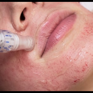 Microneedling