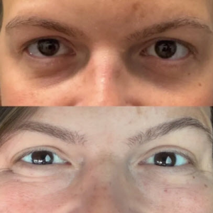 PRP + Microneedling