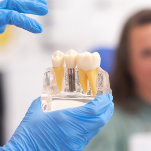 Dental Implants