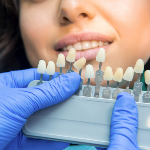 Veneers