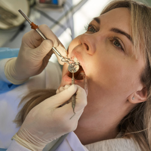 Tooth Extractions