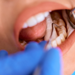 Cavity Fillings