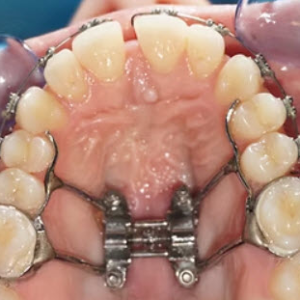 MARPE - Non-Surgical Palatal Expansion