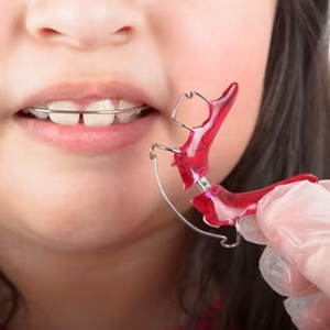 Orthodontic Retainer