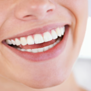 Teeth Whitening