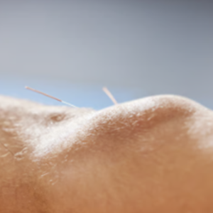 Dry Needling