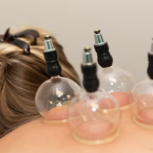 Cupping Therapy