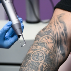 Tattoo Removal