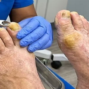 Corn and Callus Care