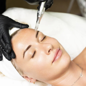 Micro-Needling