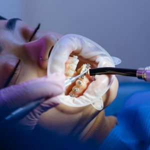 Orthodontic Braces