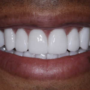 Teeth Whitening