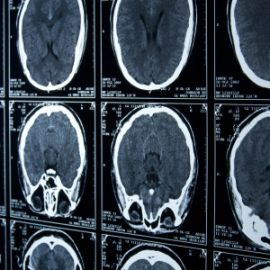 Brain Injury