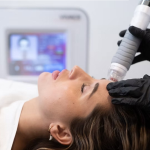 Vivace Radiofrequency Microneedling