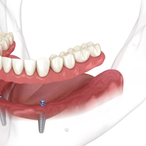 Implant Dentures