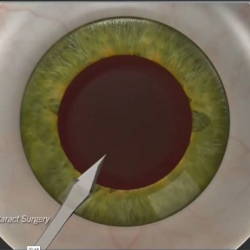 Traditional Manual Cataract Surgery