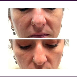 Dermal Fillers