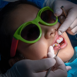 Tooth Colored Fillings