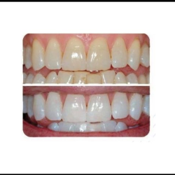 Teeth Whitening