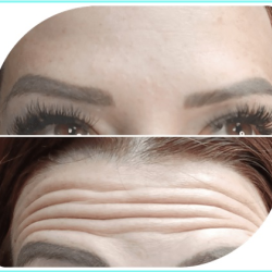 Botox Therapy