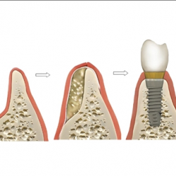 Bone Grafts