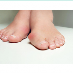 Bunions