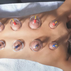 Cupping