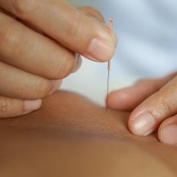 Dry Needling