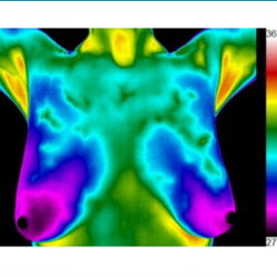 Breast Thermography