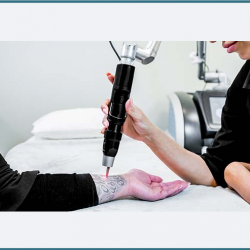 Tattoo Pigment Removal