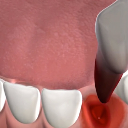  General Tooth Extractions